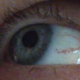 Illustration for article titled Woman has love written with a blood vessel in her eye